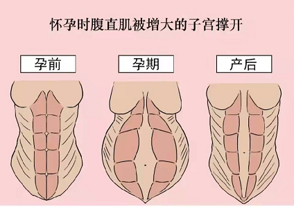 腹直肌修复加盟-王牌项目加盟代理(图1)